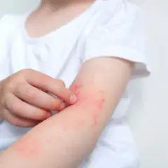 Dziecko drapie zaczerwienioną skórę na ramieniu, objaw uczulenia na psa.