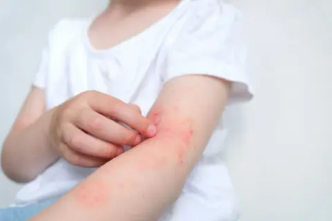 Dziecko drapie zaczerwienioną skórę na ramieniu, objaw uczulenia na psa.