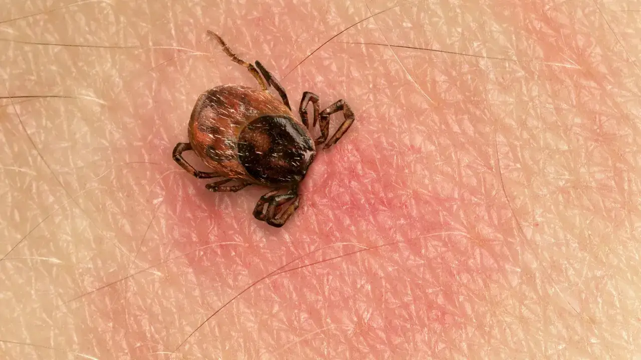Makro zbliżenie na kleszcza przyczepionego do ludzkiej skóry. Widać jego ciemne ciało, nogi i włoski na skórze.